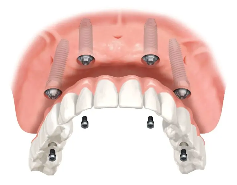 implante dentário overdenture