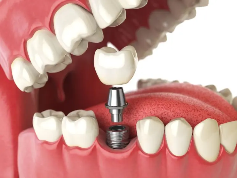 6 mitos e verdades sobre implantes dentários que você precisa entender